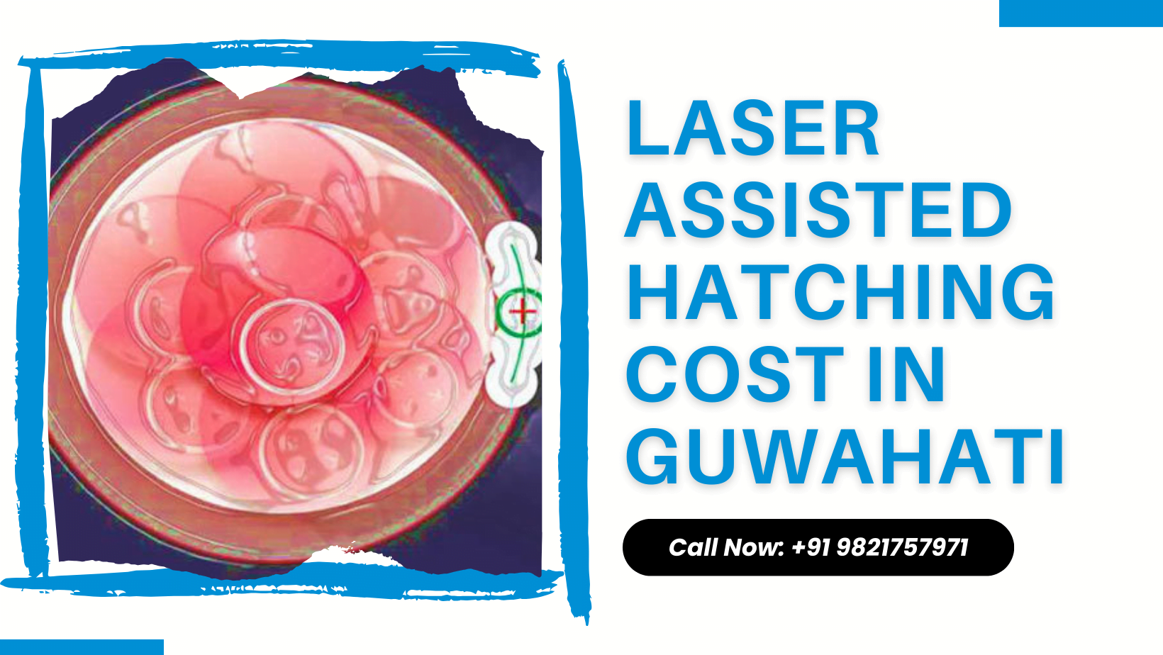 Laser Assisted Hatching Cost in Guwahati Laser Assisted Hatching Cost in Guwahati
