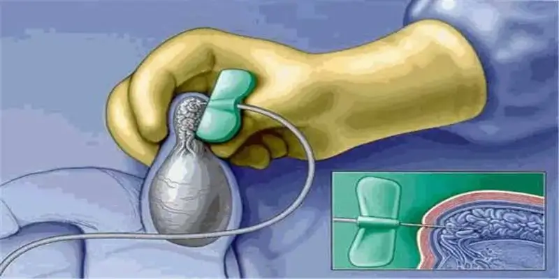 TESA Cost in Mumbai 2024 : Expert Care for Male Infertility Tesa Cost in Mumbai